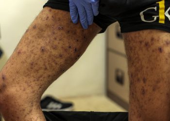 Palestinians released by Israel show signs of ‘torture, starvation’