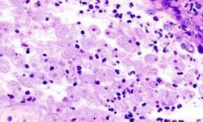 Karachi records first Naegleria death of 2025