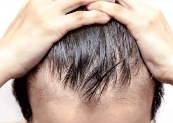 Nearly 3 Crore Pakistanis Currently Experiencing Hair Loss