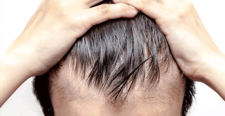 Nearly 3 Crore Pakistanis Currently Experiencing Hair Loss