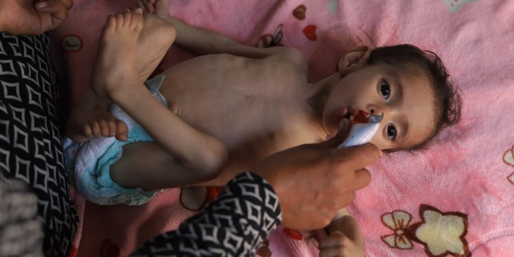 UN warns of surge in acute malnutrition among Gaza’s young children