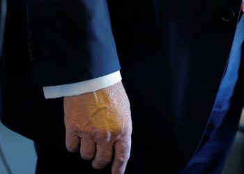 Trump diagnosed with vein condition causing leg swelling, White House says