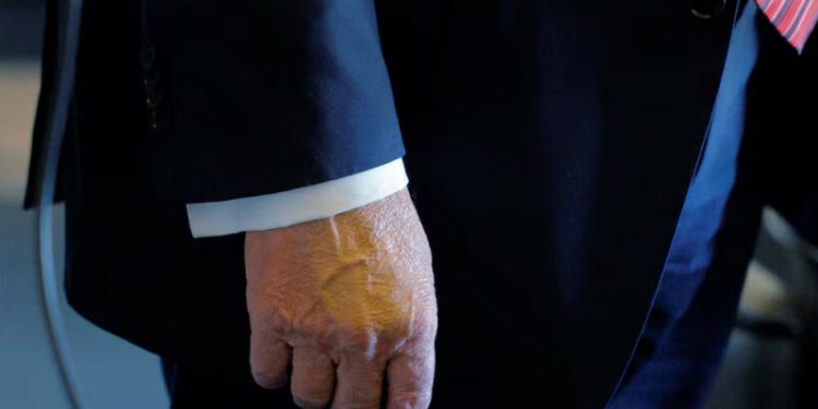 Trump diagnosed with vein condition causing leg swelling, White House says