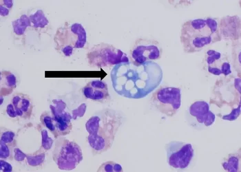 Sindh sees fifth fatality from brain-eating amoeba as Karachi man dies in hospital