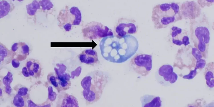 Sindh sees fifth fatality from brain-eating amoeba as Karachi man dies in hospital