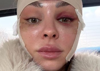 I traveled from the US to South Korea to get a facelift at 34. It boosted my confidence.